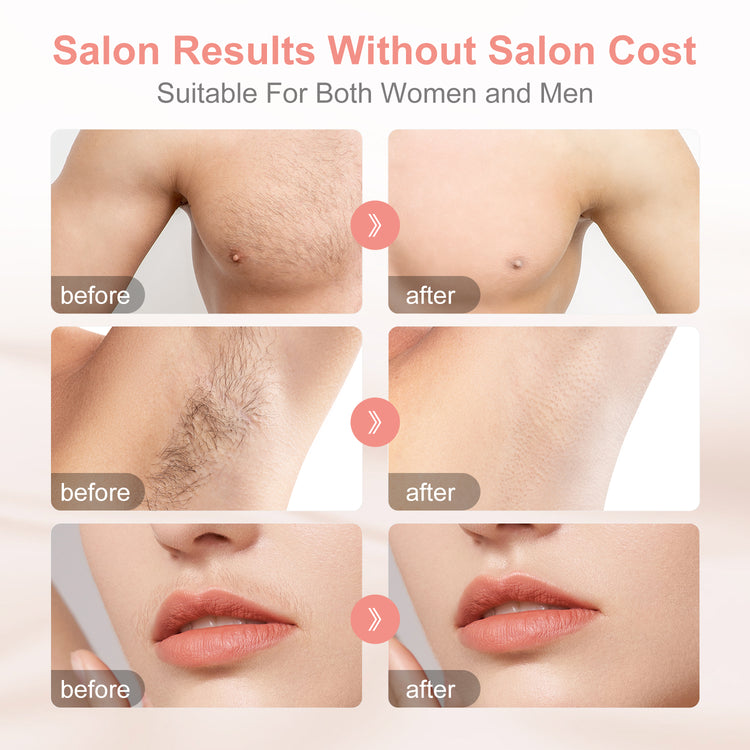 IPL (Intense Pulse Light) Permanent Hair Removal for Body and Face